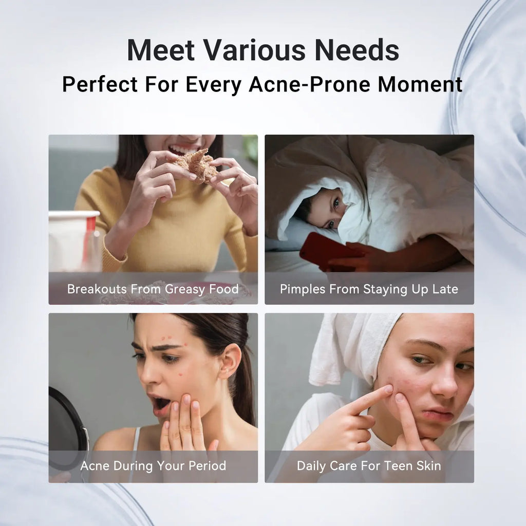 Dr.Leo Drying Lotion | Pimple Treatment & Body Acne Treatment | Visibly Shrinks Pimples in 24 Hours & Helps Fade Acne Marks in 7 Days | With 1.8%25 Encapsulated Salicylic Acid, 4%25 Niacinamide & 10%25 Sulfur (20ml) #mothersdaygift #Summervibes