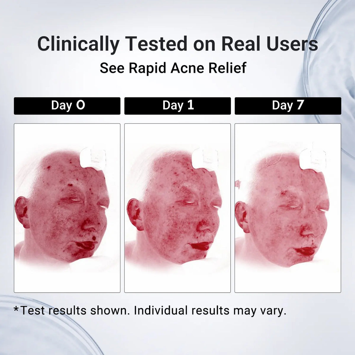 Dr.Leo Drying Lotion | Pimple Treatment & Body Acne Treatment | Visibly Shrinks Pimples in 24 Hours & Helps Fade Acne Marks in 7 Days | With 1.8%25 Encapsulated Salicylic Acid, 4%25 Niacinamide & 10%25 Sulfur (20ml) #mothersdaygift #Summervibes