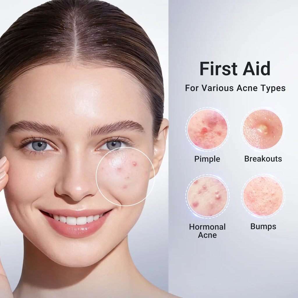Dr.Leo Drying Lotion | Pimple Treatment & Body Acne Treatment | Visibly Shrinks Pimples in 24 Hours & Helps Fade Acne Marks in 7 Days | With 1.8%25 Encapsulated Salicylic Acid, 4%25 Niacinamide & 10%25 Sulfur (20ml) #mothersdaygift #Summervibes