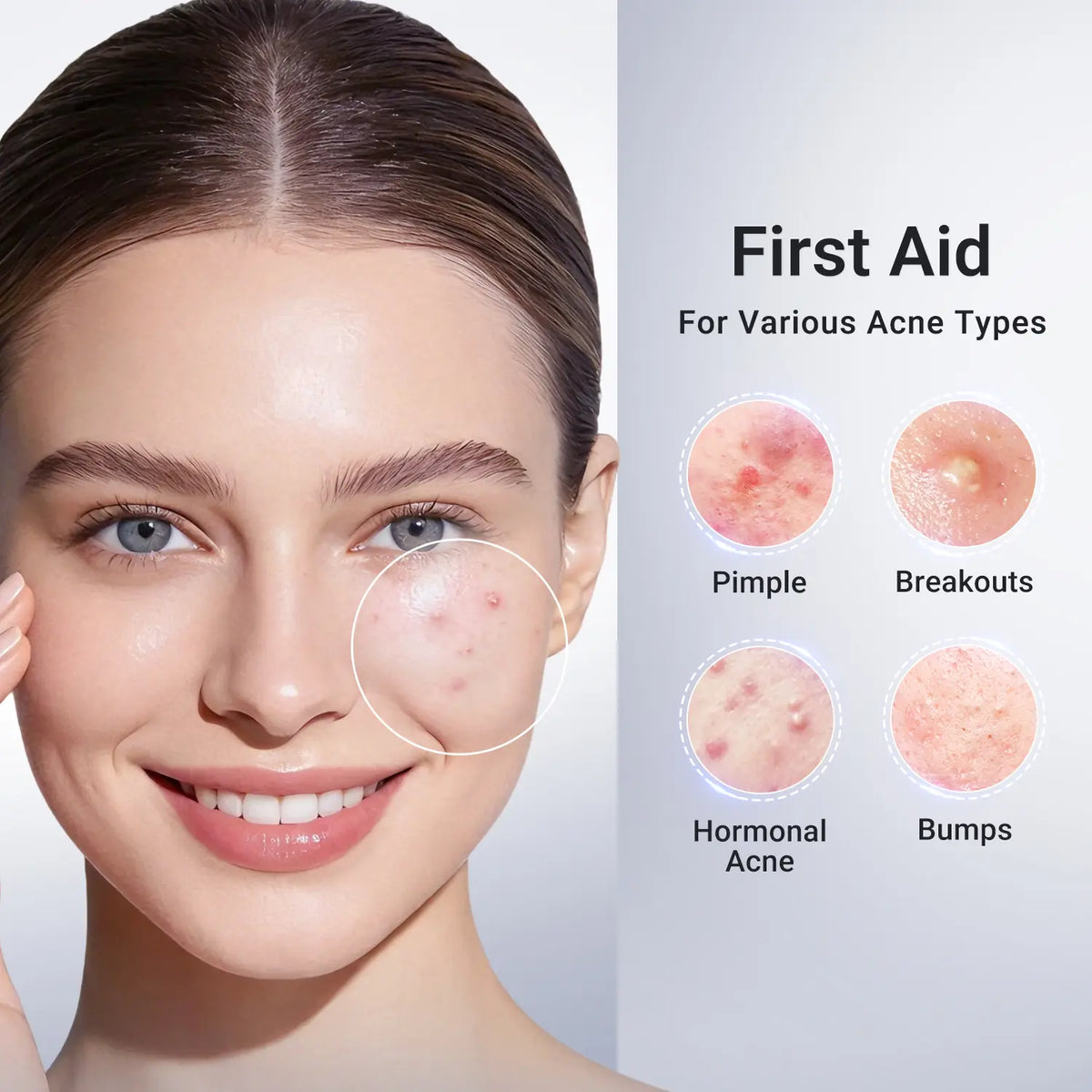 Dr.Leo Drying Lotion | Pimple Treatment & Body Acne Treatment | Visibly Shrinks Pimples in 24 Hours & Helps Fade Acne Marks in 7 Days | With 1.8%25 Encapsulated Salicylic Acid, 4%25 Niacinamide & 10%25 Sulfur (20ml) #mothersdaygift #Summervibes