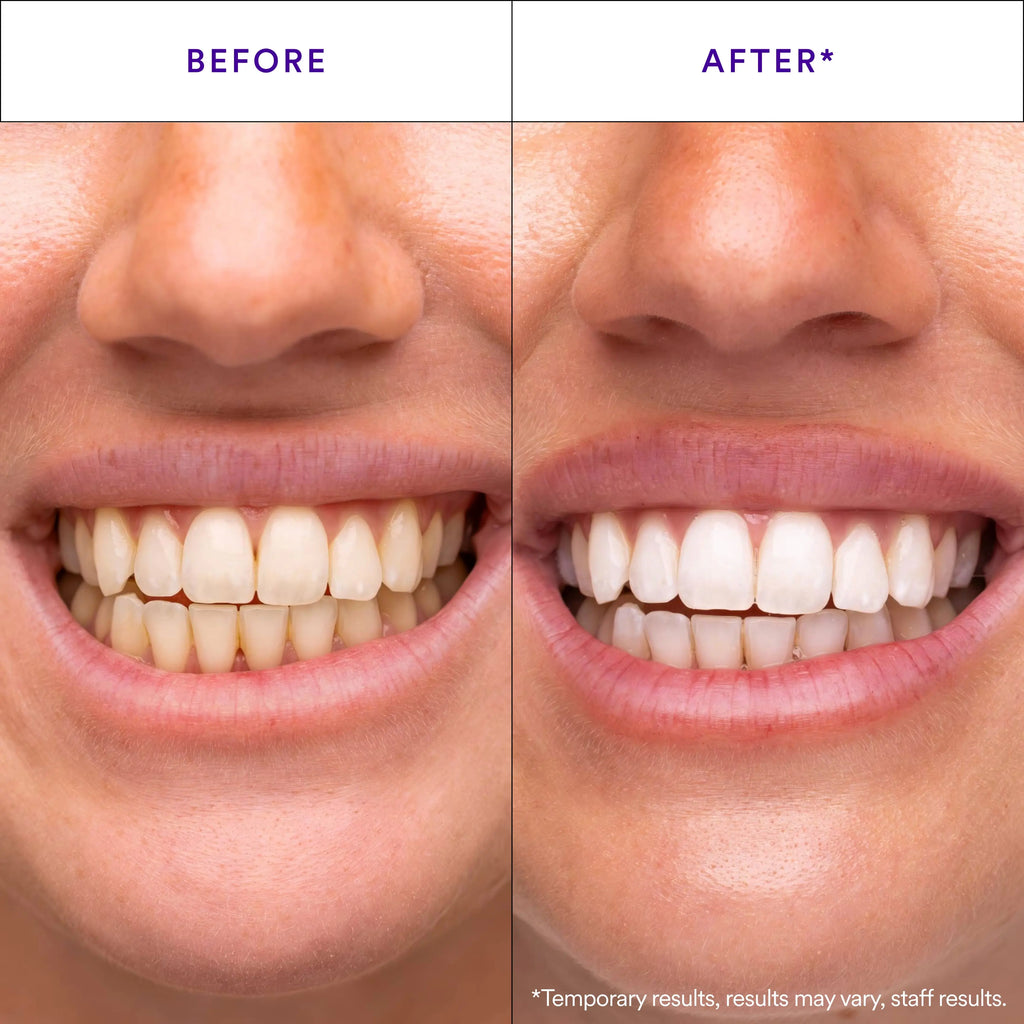 Hismile V34 Whitening Strips, Teeth Whitening Strips, Purple Tooth Whitening, Combining Whitening and Colour Correction